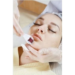 Trattamenti di micro needling