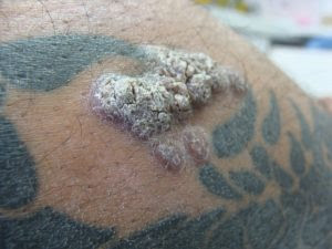 reazione al tatuaggio granuloma
